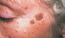 Seborrheic Keratoses on the face